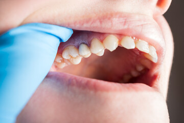Gingival recession, yellow and crooked teeth covered with tartar and plaque, dental issues and oral...