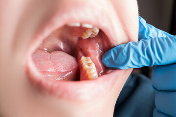 Filling teeth with dental composite photopolymer, tartar, plaque, dental issues and oral health...