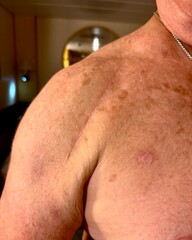 Fototapeta premium Close-up of a well healed shoulder implant surgery, scar on an older man