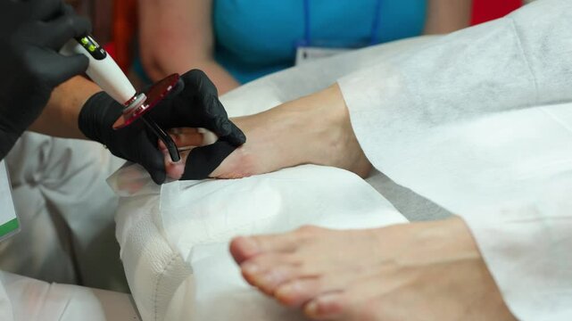 Podologist in gloves puts a titanium thread on toenail with special polymerization ultraviolet lamp.