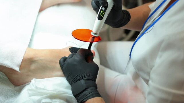 Podologist in gloves puts a titanium thread on toenail with special polymerization ultraviolet lamp.