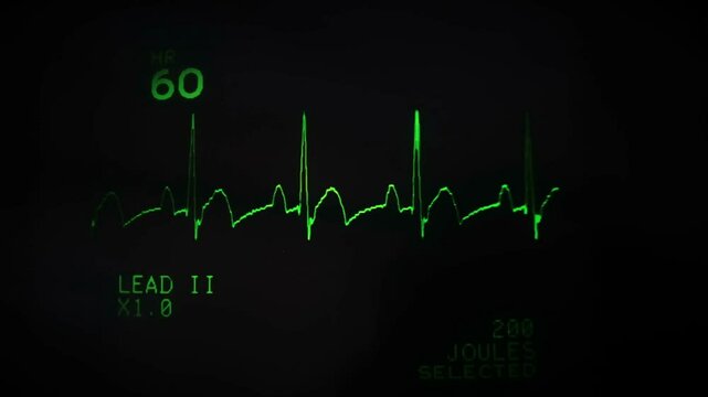 close-up ekg heart monitor flatline hospital machine ecg black and green line pulse.