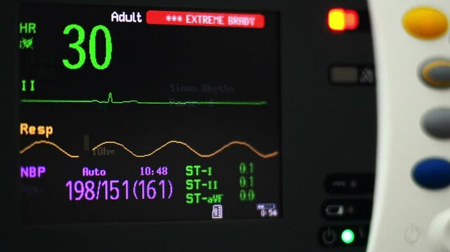 close-up ekg heart monitor flatline hospital machine ecg black and green line pulse.