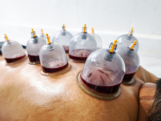 Wet cupping therapy (Hijama) on a man's back,