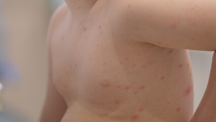 A child dealing with a skin condition chickenpox is captured in soft focus portraying their...