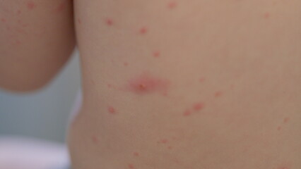 Exploring Skin Conditions in Infants chickenpox. A Detailed CloseUp Examination of Symptoms and Care
