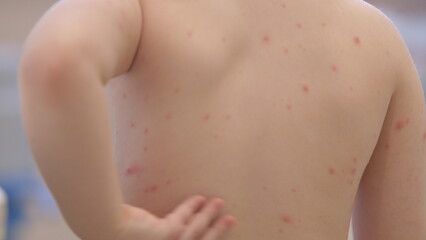 Child with a Skin Rash chickenpox located on Their Back A Guide for Parents Seeking Assistance