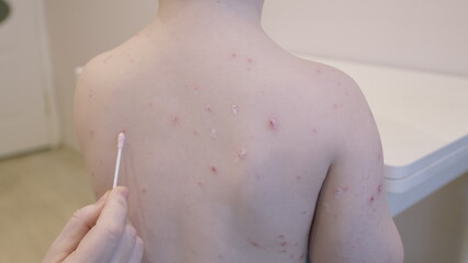 Child Suffering from Skin Condition chickenpox Accompanied by Lesions Present on Their Back