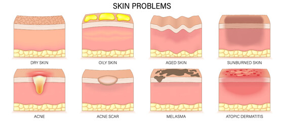 Structure of oily skin. Comparison of normal and oily skin. Facial skin problems. Vector for advertising about beauty and medical treatment.