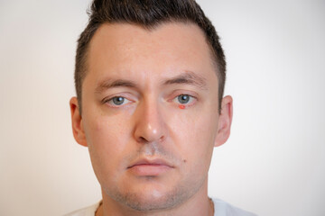 Fototapeta premium Man's eyes with pus redness like chalazion caused by blocked sebaceous glad on lower eyelid. Hordeolum. Viral infection