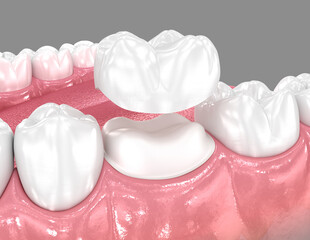 Fototapeta na wymiar Dental crown placement over tooth. 3D illustration
