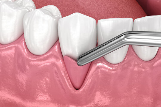 Gingiva Recession: Soft tissue graft surgery. 3D illustration of Dental  treatment