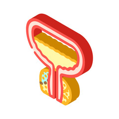 prostatectomy urology isometric icon vector illustration
