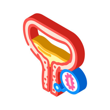 urethritis urology isometric icon vector illustration