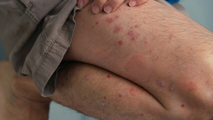 Fototapeta premium A man with chronic small plaque Psoriasis on his legs.