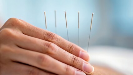 acupuncture needle stress concept Acupuncture needles placed in a person's hand for therapeutic treatment.