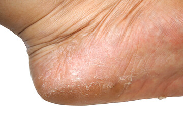 Close-up of Dry and Cracked Skin on Human Foot Heel Surface