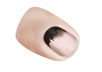 Subungual Hematoma showing a dark spot beneath the nail caused by internal bleeding from injury. Useful for nail trainers, first aid awareness, and medical illustrations.