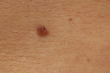 Man with mole on his skin, closeup