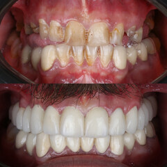 Smile design treatment with cosmetic dentistry. Laminate veneers and zirconia porcelain for a new...