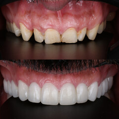 Smile design treatment with cosmetic dentistry. Laminate veneers and zirconia porcelain for a new smile through dental design. Dental before after and smile makeover.