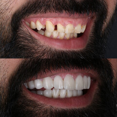 Smile design treatment with cosmetic dentistry. Laminate veneers and zirconia porcelain for a new smile through dental design. Dental before after and smile makeover.
