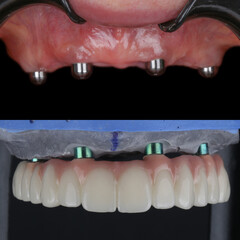 Treatment of tooth loss with jawbone implants. Full arch denture prosthesis on multiple dental...