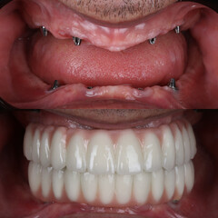 Fototapeta premium Treatment of tooth loss with jawbone implants. Full arch denture prosthesis on multiple dental implants. Dental before after and smile makeover.