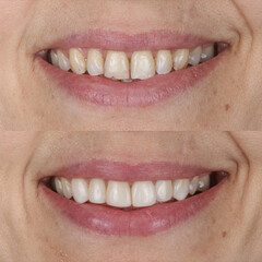 Smile design treatment with cosmetic dentistry. Laminate veneers and zirconia porcelain for a new smile through dental design. Dental before after and smile makeover.