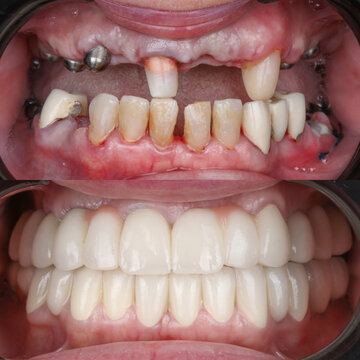 Full-arch denture prosthesis with dental implants placed in the jawbone. Full arch implant treatment with porcelain prosthesis. Dental before after and smile makeover.

