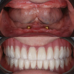 Full-arch denture prosthesis with dental implants placed in the jawbone. Full arch implant...