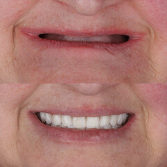 Full-arch denture prosthesis with dental implants placed in the jawbone. Full arch implant...