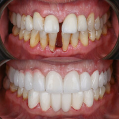 Full mouth porcelain crown treatment in cosmetic dentistry. Correction of crooked and deformed teeth with porcelain veneers. Dental before after and smile makeover.

