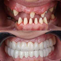 Full mouth porcelain crown treatment in cosmetic dentistry. Correction of crooked and deformed...