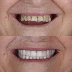 Obraz premium Dental treatment in dentistry. Smile design treatment with dental design. New tooth design with porcelain crowns. Full arch dental treatment. Dental before after and smile makeover.