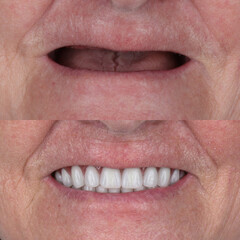 Full-arch denture prosthesis with dental implants placed in the jawbone. Full arch implant...