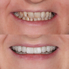 Full mouth porcelain crown treatment in cosmetic dentistry. Correction of crooked and deformed teeth with porcelain veneers. Dental before after and smile makeover.

