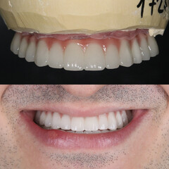 Full-arch denture prosthesis with dental implants placed in the jawbone. Full arch implant...