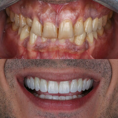 Full mouth porcelain crown treatment in cosmetic dentistry. Correction of crooked and deformed teeth with porcelain veneers. Dental before after and smile makeover.

