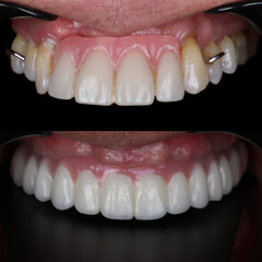 Full-arch denture prosthesis with dental implants placed in the jawbone. Full arch implant...