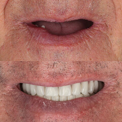 Obraz premium Full-arch denture prosthesis with dental implants placed in the jawbone. Full arch implant treatment with porcelain prosthesis. Dental before after and smile makeover.