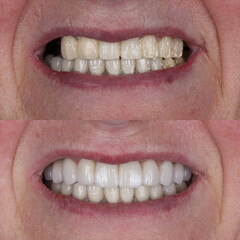 Fototapeta premium Dental implant treatment with oral surgery. Treatment of tooth loss. Porcelain dental prosthesis placed on implants embedded in the jawbone. Dental before after and smile makeover.