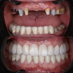 Fototapeta premium Treatment of front incisors with dental implants through oral surgery. Implant treatment of anterior aesthetic zone with E-Max and zirconia porcelain. Dental before after.