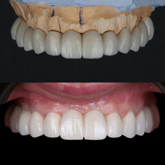 Full-arch denture prosthesis with dental implants placed in the jawbone. Full arch implant treatment with porcelain prosthesis. Dental before after and smile makeover.

