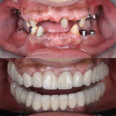 Full-arch denture prosthesis with dental implants placed in the jawbone. Full arch implant...