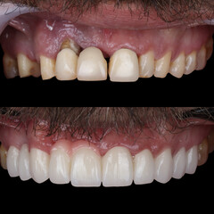 Full mouth porcelain crown treatment in cosmetic dentistry. Correction of crooked and deformed...