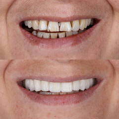 Obraz premium Dental design treatment in aesthetic dentistry. Full mouth smile makeover with glass ceramic porcelains. Dental veneers and bridge treatment. Dental before after and smile makeover.