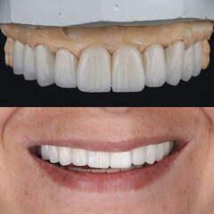 Treatment of all teeth in the mouth with porcelain crowns in dentistry. Smile design treatment. Smile makeover with digital dentistry. Dental before after.