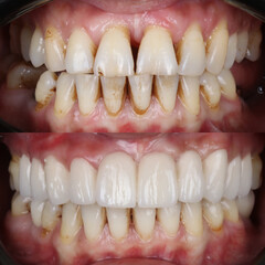 Treatment of all teeth in the mouth with porcelain crowns in dentistry. Smile design treatment. Smile makeover with digital dentistry. Dental before after. © UniqDream