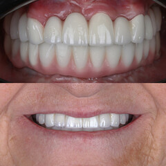 Smile design treatment with cosmetic dentistry. Laminate veneers and zirconia porcelain for a new...
